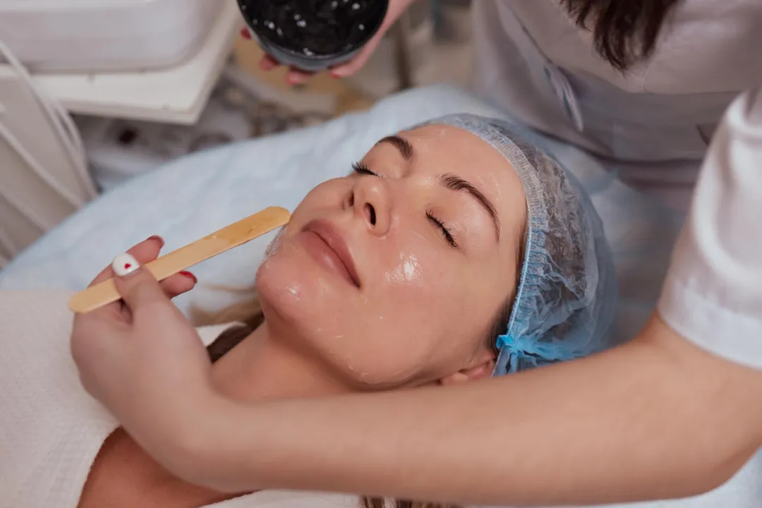 Akne İzleri ve Leke Tedavisinde TCA Peeling