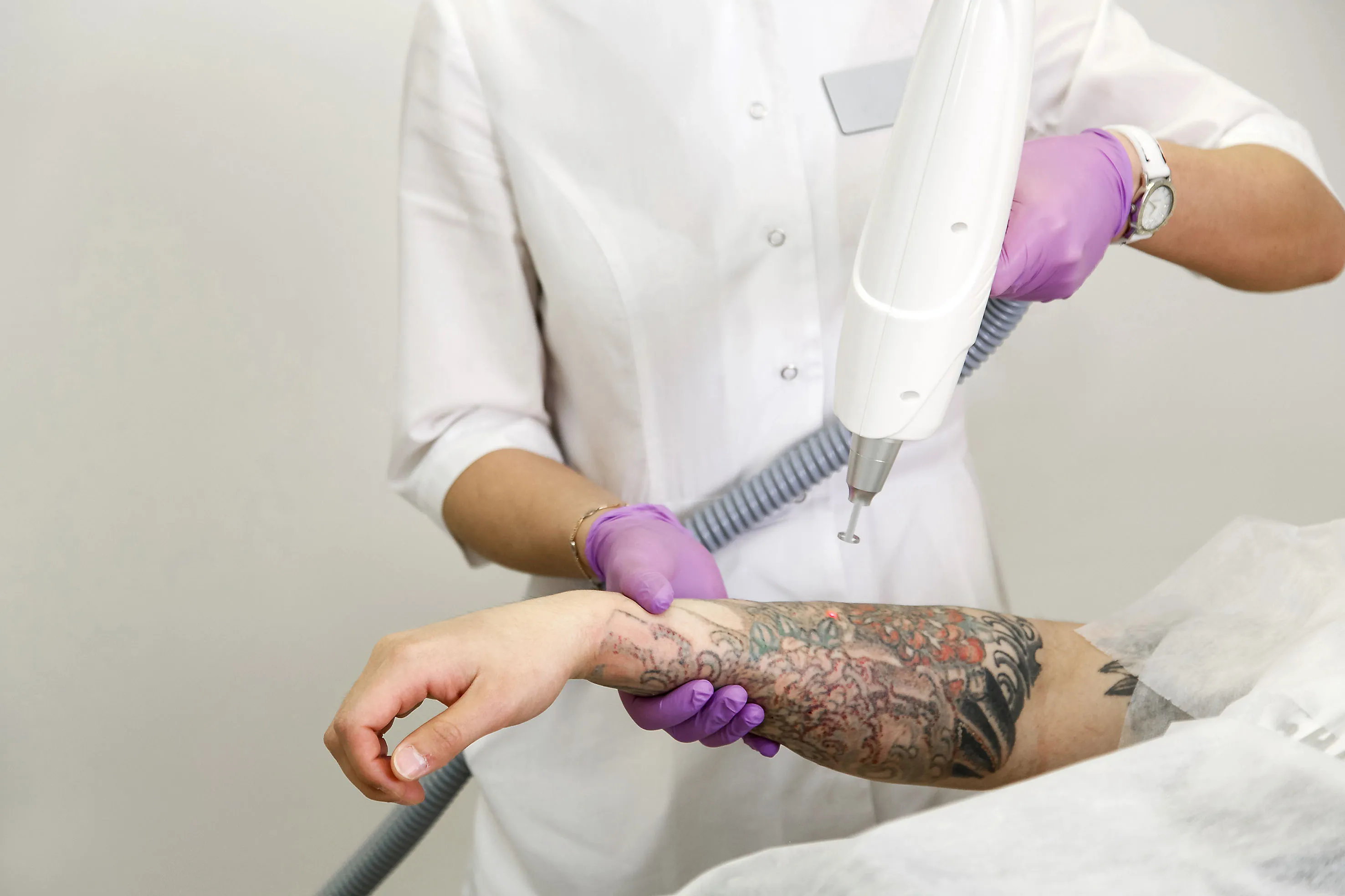 Dövme Silme