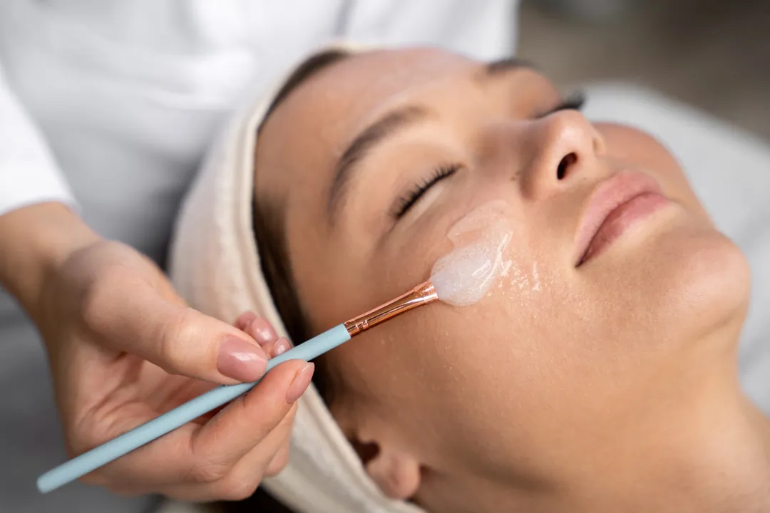 TCA Peeling